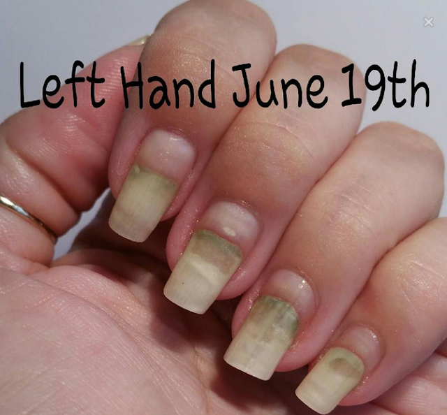 Ashley Is Polishaddicted Mentality Nail Polish There S More To The Next Is Leesha 4leesha On Instagram You Can See Her Post Nails Here Who Wound Up With A Staph Infection And Fungus In Addition To The Onchylosis