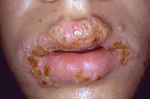 Nanda%2BHerpes%2BSimplex%2B-%2BNursing%2BDiagnosis.jpg