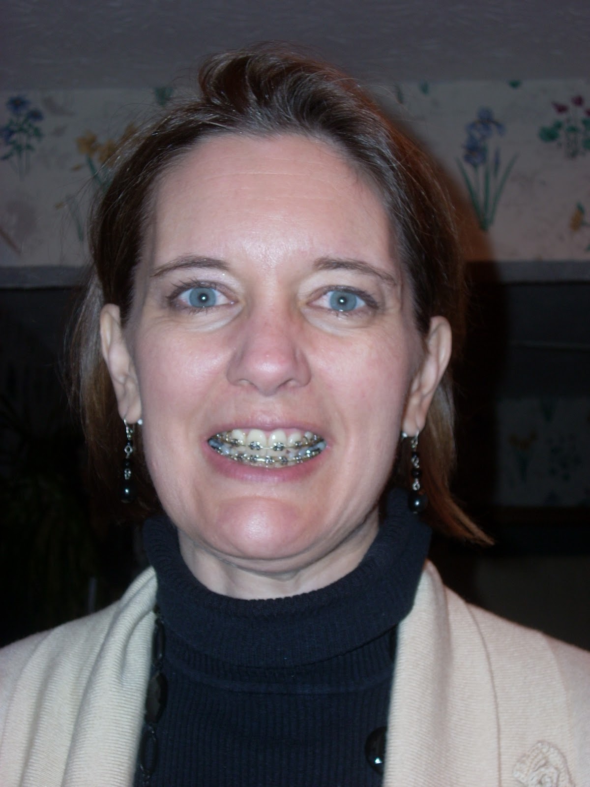 braces on