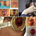 Mengobati Wasir Parah Dg Ambeclear dan Propolis thumbnail