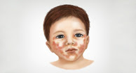 Picture of Acrodermatitis 