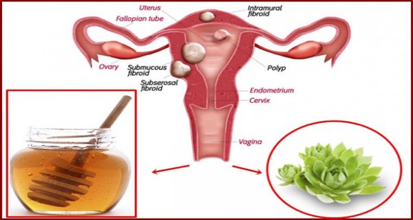 The Mixture Of These 2 Ingredients Kills Cysts And Fibroids These 2 Ingredients Kills Cysts And Fibroids