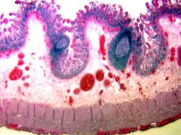 bowel infarction