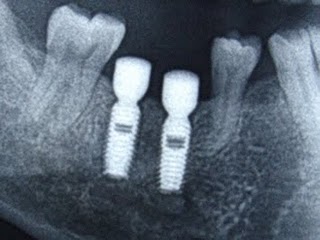Featured image of post Dente Encavalado Embaixo Os dentes tortos ou dentes encavalados podem ter diversas causas sendo que o tratamento adequado para corrigir ou alinhar os dentes pode diferir de acordo com essas mesmas causas