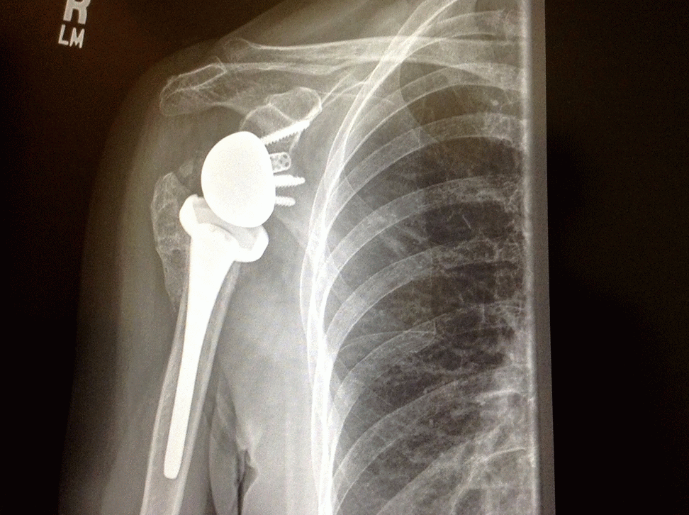Reverse Total shoulder replacement surgery, A Patient's Point of View December 2014