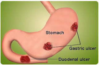 Stomach Ulcer Antibiotics as a Cure for Stomach Ulcer