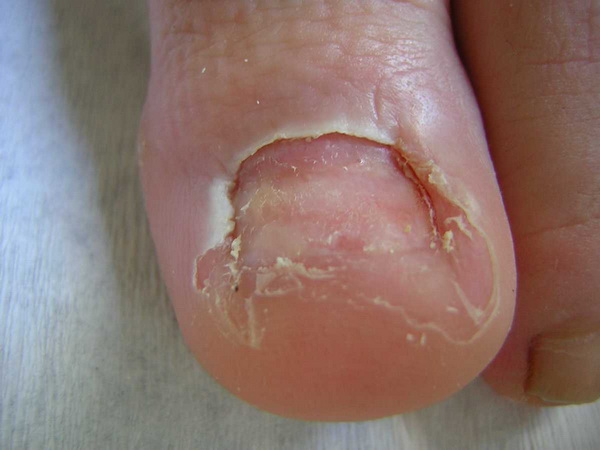 Las uñas la fragilidad el tratamiento