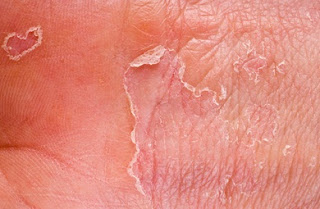 ubat kulit kering dan gatal ubat kulit kepala gatal ubat kulit gatal ubat kulit berminyak ubat kulit rawatan kulit kering rawatan kulit gatal Eczema ubat kulit kering dan gatal ubat kulit kepala gatal ubat kulit gatal ubat kulit berminyak ubat kulit rawatan kulit kering rawatan kulit gatal
