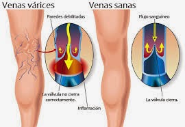 El tratamiento del hematoma en el pie después del magullado a varikoze