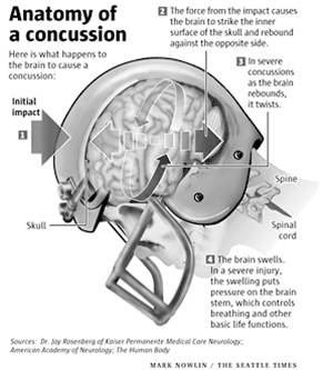 Cause And Effects Of Concussions In Football