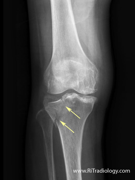Return to Sport J.J. Watt Tibial Plateau Fracture