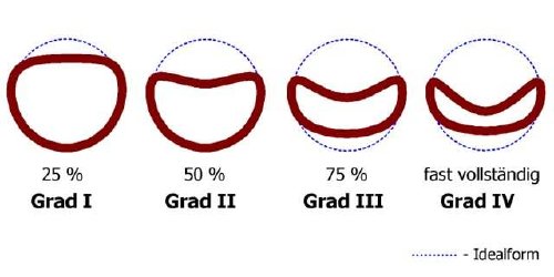 trachealkollaps hund video