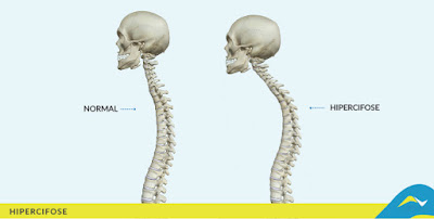 As patologias relacionadas à hipercifose