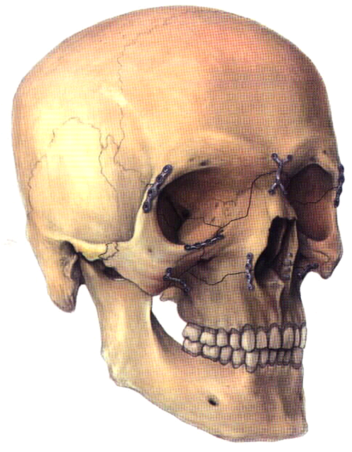 Define Fracture The area between a superior planedrawn through the zygomatico-frontal -4.bp.blogspot.com