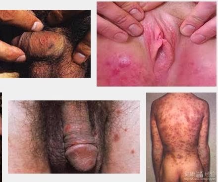 obat herbal benjolan sipilis, obat sipilis, pengobatan sipilis
