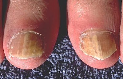Can Anti Fungal Paint Solve Mould Health Issues Can Anti Fungal Paint Solve Mould Health Issues