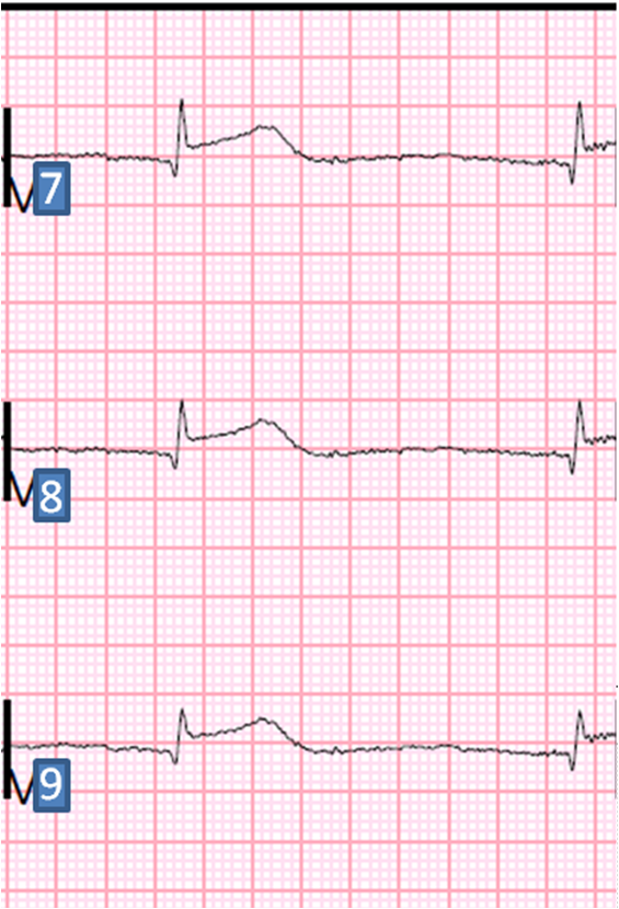 Dr. Smith's ECG Blog Chest pain and Bradycardia