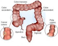 Cancerul intestinal