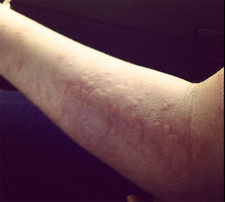 paper wasp sting paper wasp sting