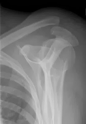 Acromio-clavicular joint dislocation.