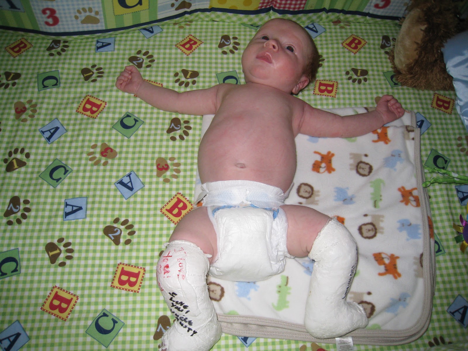 Their Little Footprints Tiny Baby in Leg Casts