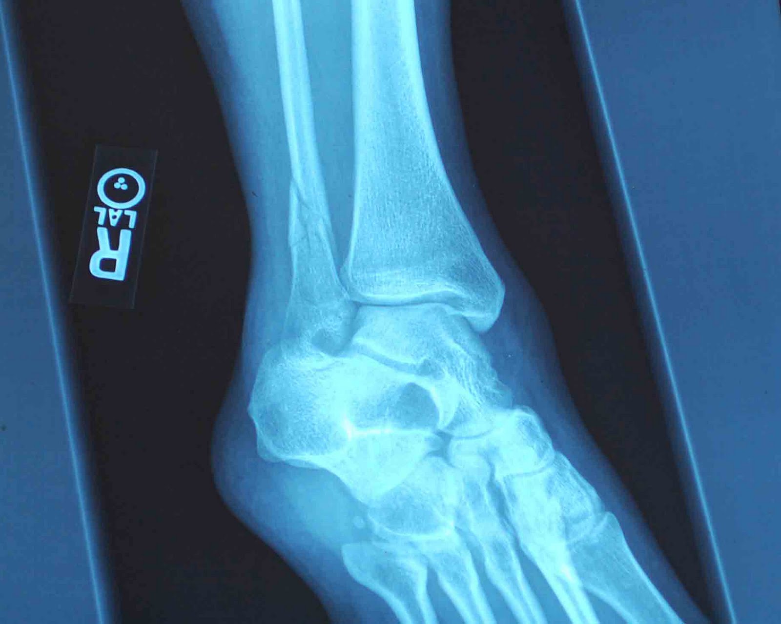 Hermitgirl of the Mountains Broken Ankle XRays PreOp