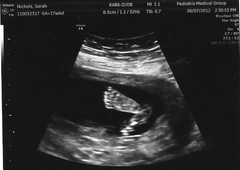 The Nichols 18week Ultrasound