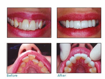 teeth overcrowded before crowded smile braces crowns problem dental dentistry makeover patient bridge cosmetic winnipeg dentist