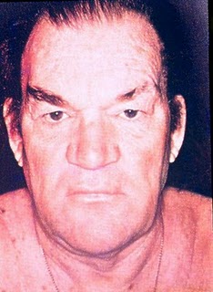 Progressive supranuclear palsy SEMIOLOGIA MÉDICA: Fácies