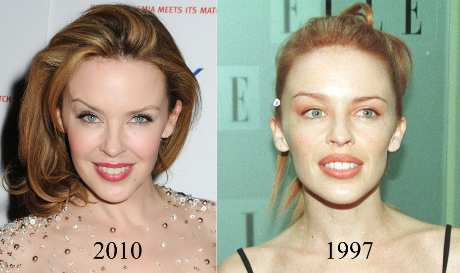 Chatter Busy Kylie Minogue Plastic Surgery