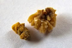 Gallstone Home Remedy To Dissolve Gallstones Permanently Gallstone Home Remedy To Dissolve Gallstones Permanently