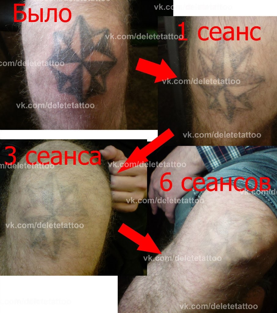 Татуировка покрылась волдырями Татуировка покрылась волдырями