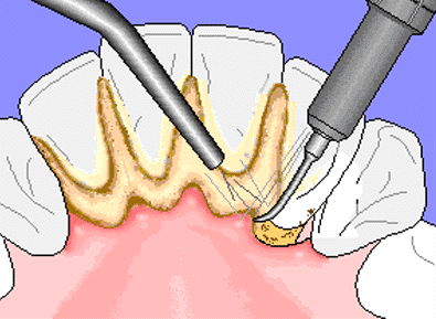 Tooth Scaling Procedure