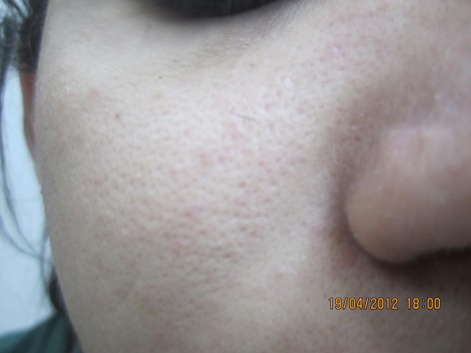 Dry Skin Open Pores Face