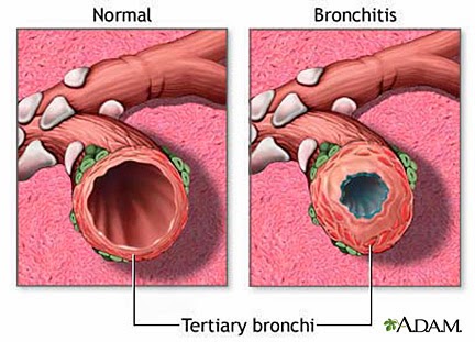 ICD 9 Code For Bronchitis