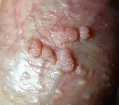 Kutil di Testis Kutil di Testis