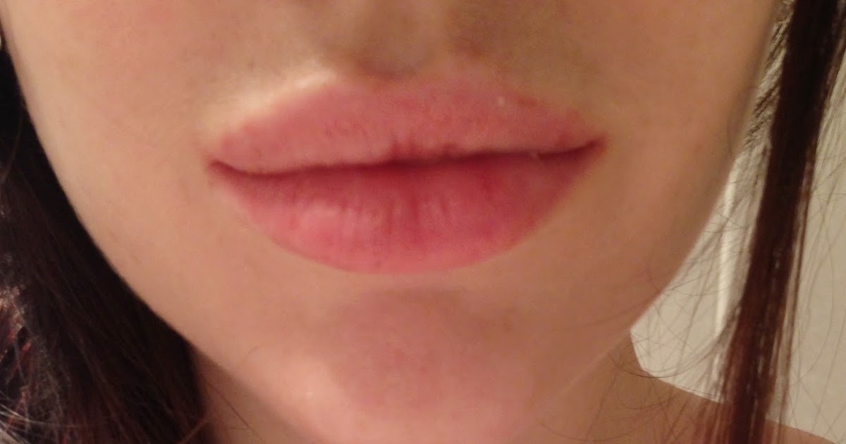 Labbra perfette grazie all'acido ialuronico | Narendras Blog