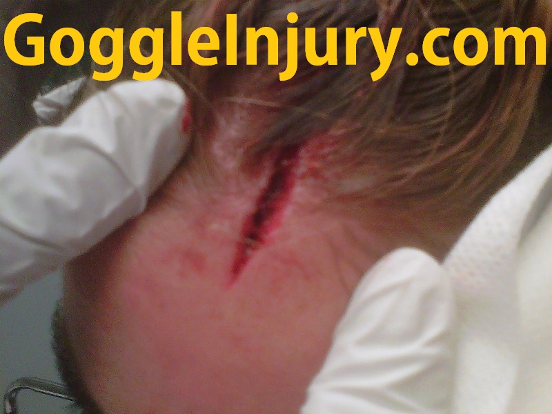 Field Hockey Injury