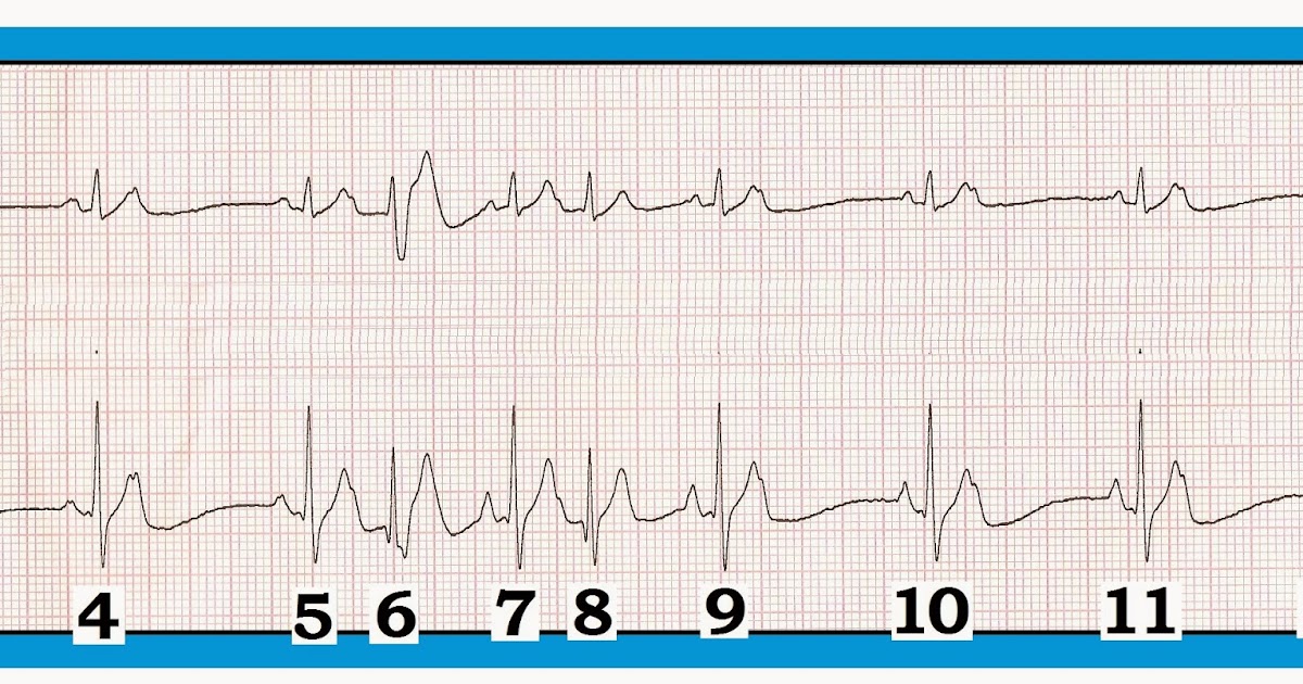 ECG Interpretation ECG Interpretation Review 78 (PACs Atrial