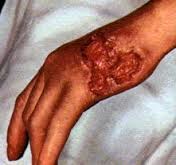 sipilis obat sipilis alami