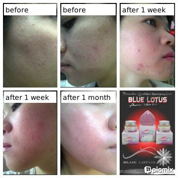 Blue Lotus Acne Skin Care