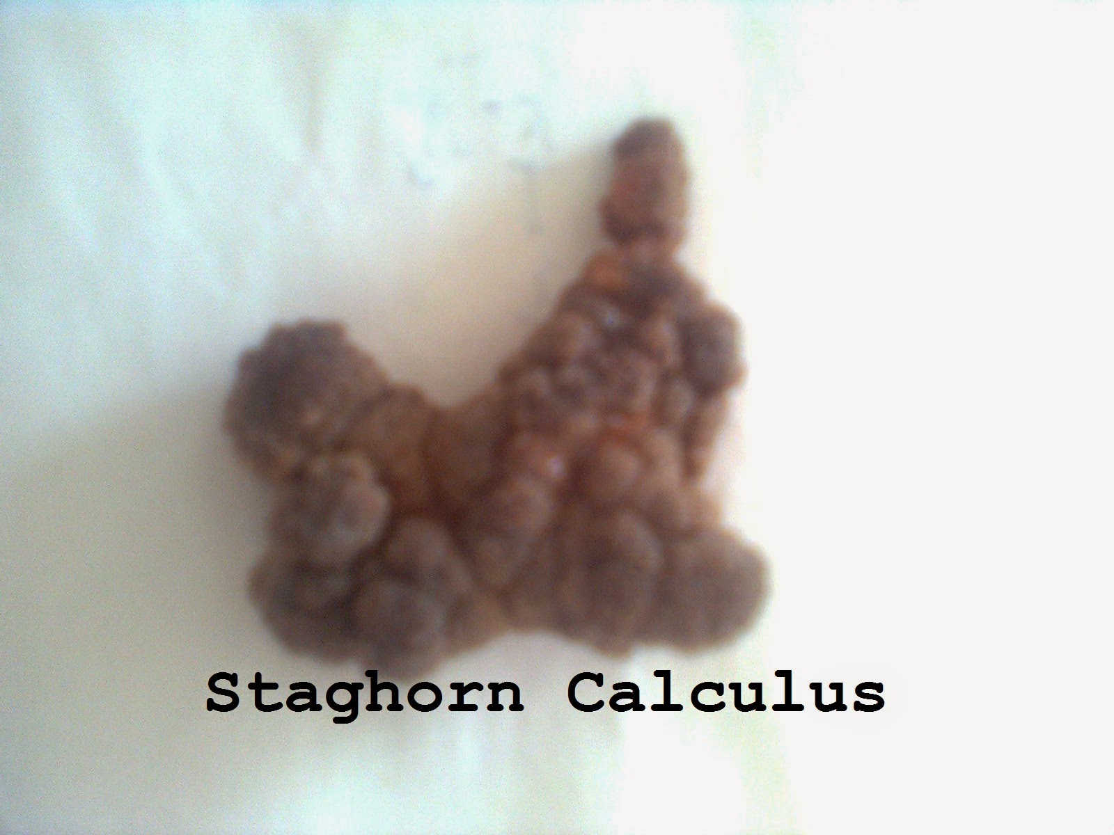 Staghorn Calculus Staghorn Calculus