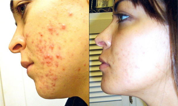 Best Tips For Cystic Acne: Best treatments for cystic acne Best Tips For Cystic Acne: Best treatments for cystic acne