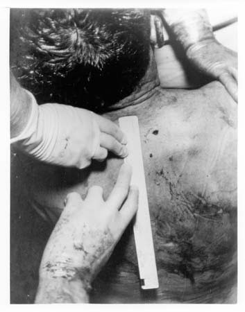 00e.+JFK+Autopsy+Photo.jpg