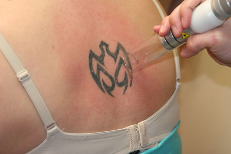 the best tattoo ink removal methods 2010 ink tattoo the best tattoo ink removal methods 2010 ink tattoo