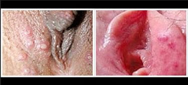 Obat Tradisional Bintil Bintil Di Bibir Vagina Obat Tradisional Bintil Bintil Di Bibir Vagina