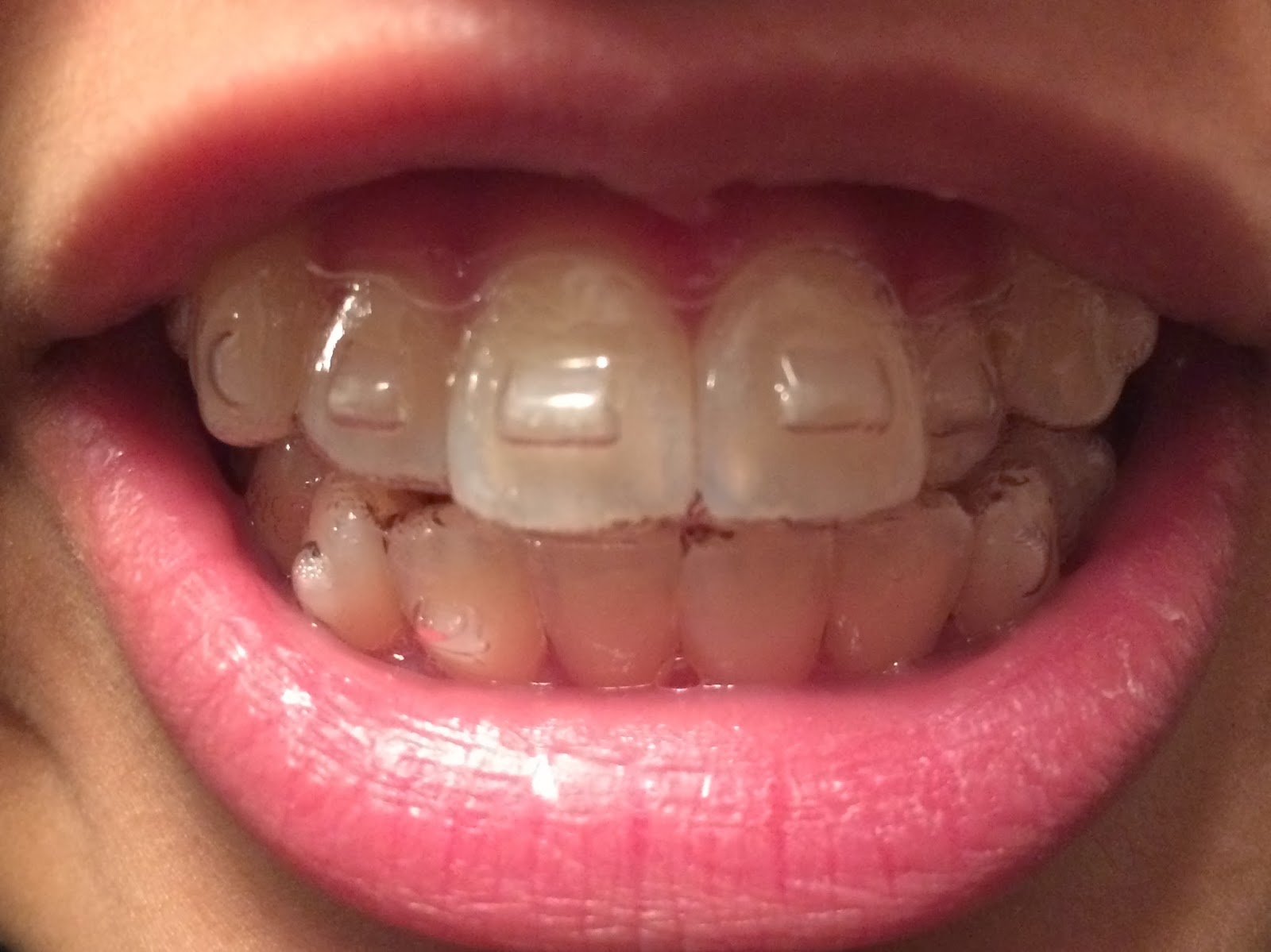 Invisalign Treatment Experiences r/dubai