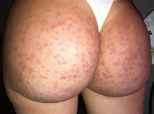 Efectos secundarios de los esteroides en la piel