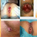 Obat Anti Wasir Selain AMBEVEN thumbnail