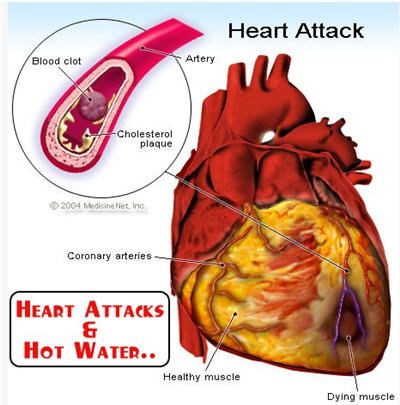 sakit jantung - Hentikan tabiat minum air sejuk selepas makan Sakit+jantung+dan+penyebabnya